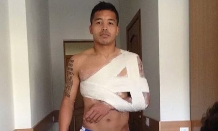 Вместо перелома — вывих