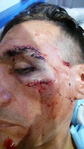 Тиралонго сошел с «Вуэльты Испании»