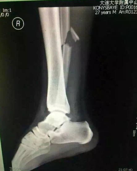 Китайские СМИ опубликовали рентгеновский снимок ноги Конысбаева