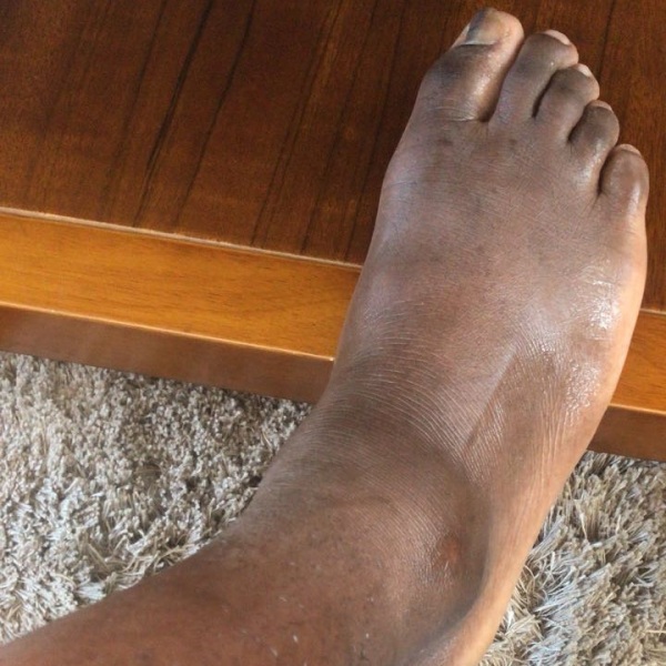 Твумаси усугубил травму и может пропустить матч с «Вильярреалом»