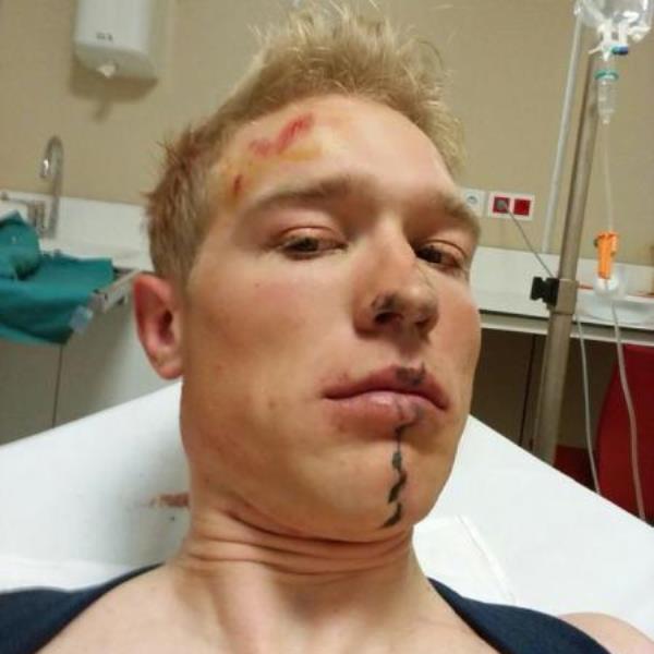 Новичок «Астаны» сломал ключицу на тренировке