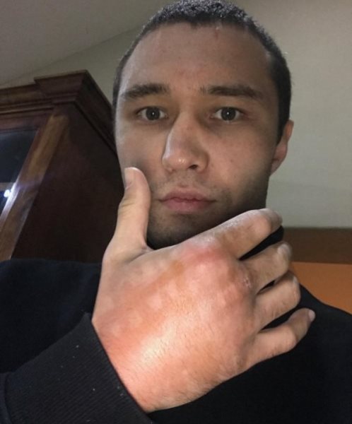 Уроженец Казахстана Липинец умолял выпустить его против Гарсии даже с травмой руки