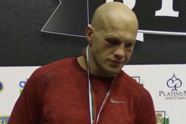 Синяки, ушибы и ссадины. Как выглядит лицо Левита после проигранного боя за «золото» турнира в Болгарии