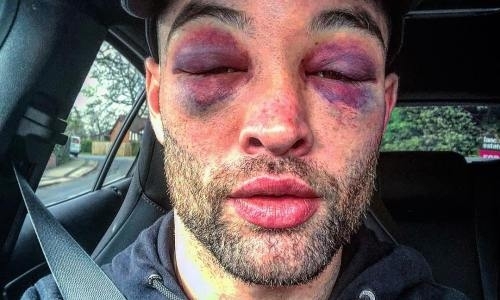 Живого места не осталось. «Фанат Головкина» до неузнаваемости избил своего оппонента