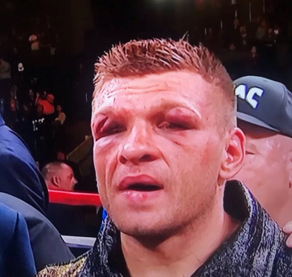 Появилось фото жуткой травмы Деревянченко после боя с Головкиным