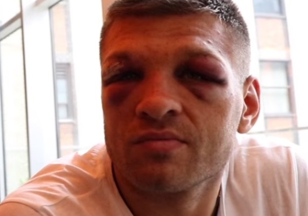 Больно смотреть. Как лицо Деревянченко выглядит после ударов Головкина на следующий день. Фотофакт