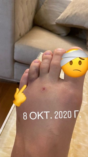 Хабиб Нурмагомедов показал фото травмы, которую получил перед боем с Гэтжи