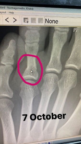 Хабиб Нурмагомедов показал фото травмы, которую получил перед боем с Гэтжи