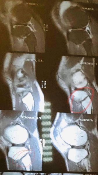 Украинский нокаутер снялся с боя против Турсынбая Кулахмета. Он назвал причину и показал фото