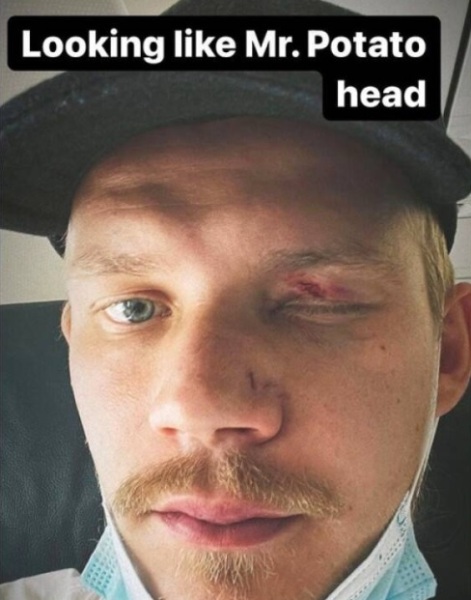 Футболист сборной Казахстана сломал финну нос и оставил «фингал» под глазом. Фотофакт