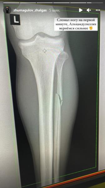 Казахстанский боец UFC сломал ногу. Фото