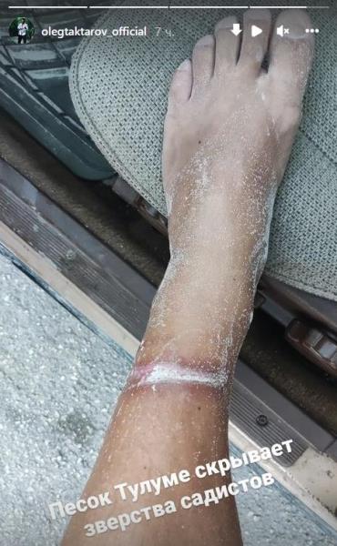 «Песок скрывает зверства садистов». Олег Тактаров показал фото после избиения в Мексике