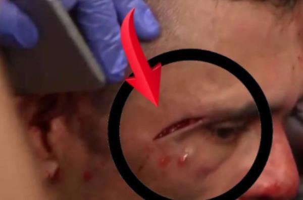 Появилось фото страшной сечки из третьего боя Сергея Морозова в UFC