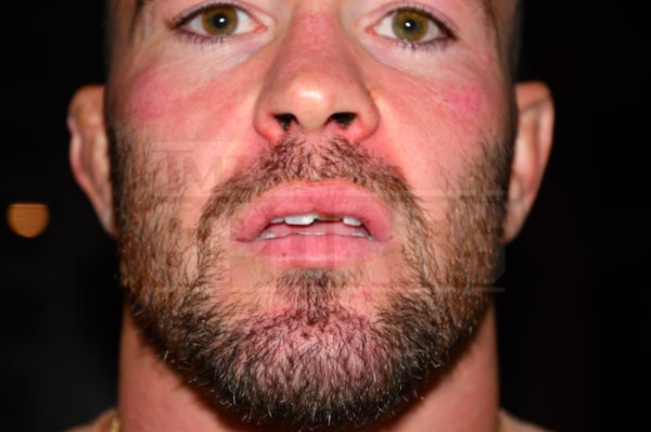 Опубликовано последствие нападения Масвидаля на Ковингтона. Фото