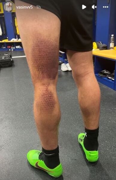 Пропустит матч с «Астаной»? Лидер обороны «Кайрата» показал травмированную ногу. Фото