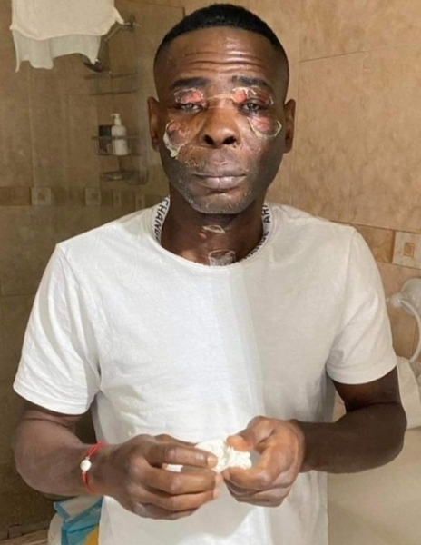 «Шакал» Ригондо показал страшное фото своего лица после взрыва скороварки у него в руках