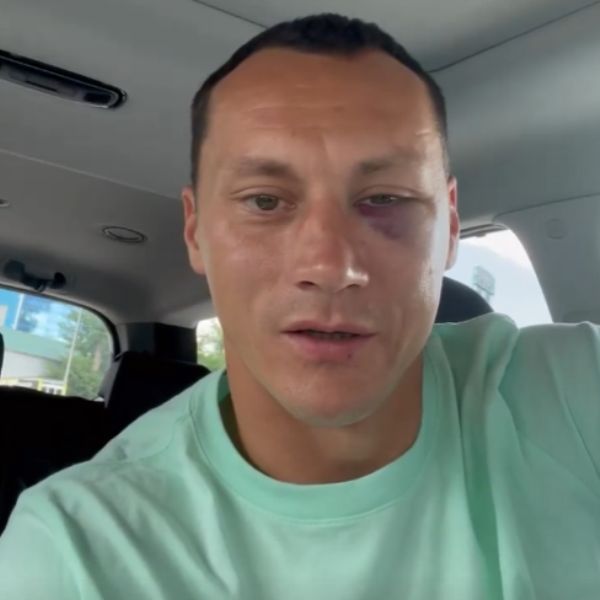 «Сломалась лицевая кость». Шацкий показал страшные последствия травмы и обратился к казахстанцам