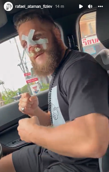 Уроженец Казахстана показал фото сломанного носа после победы над экс-чемпионом UFC