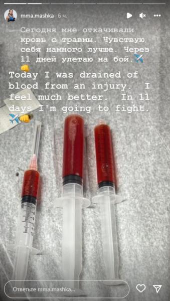 «Сегодня мне откачивали кровь». Казахстанская девушка-боец UFC показала последствия своей травмы. Фото