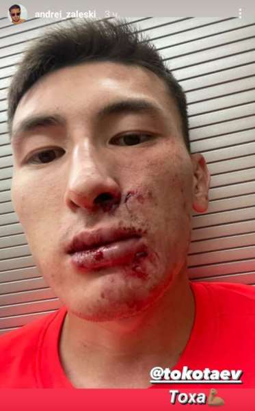 Появилось фото лица вратаря «Турана» после страшного столкновения с игроком «Кайрата»