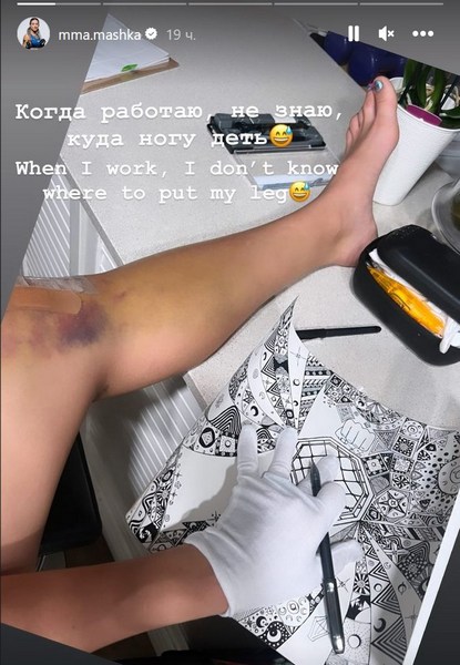 Первая казахстанка в UFC показала свое колено после операции. Фото