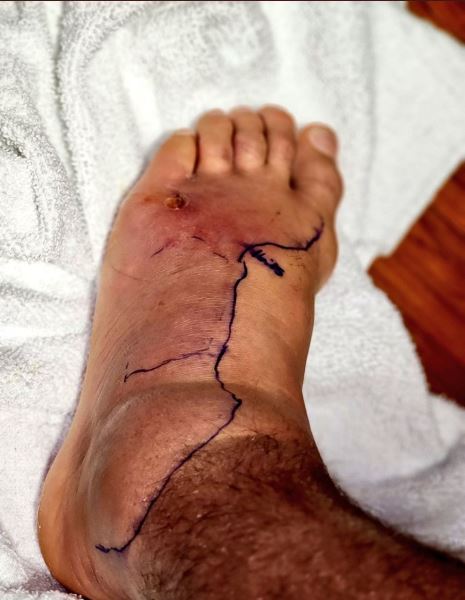 Один из лучших бойцов UFC показал последствия заражения стафилококковой инфекцией. Фото