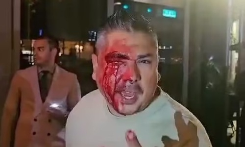 Американцу разбили лицо в кровь из-за Месси и Бекхэма