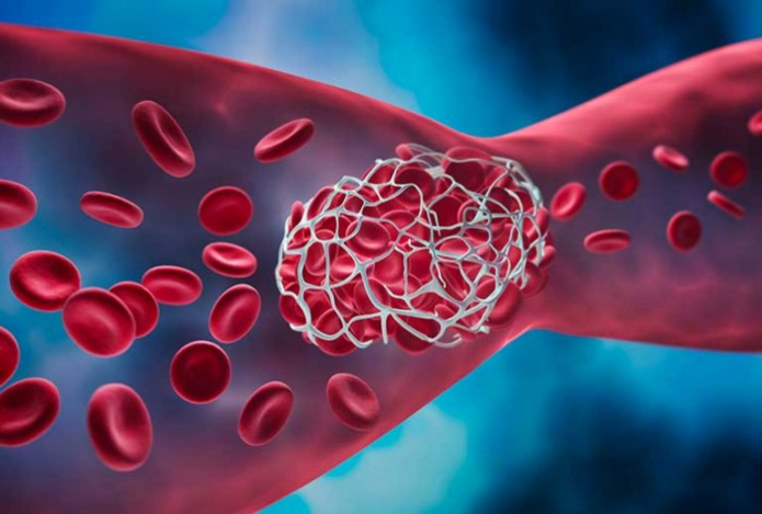 Тромбоз уносит миллионы жизней. Как от него защититься и вовремя выявить