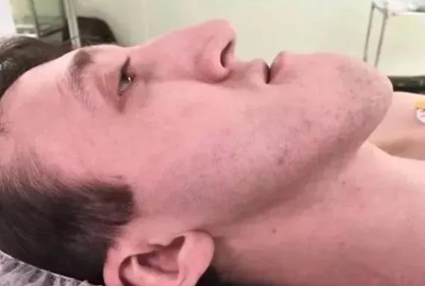 «Вы не видели человека некрасивее меня». Врачи «подарили» россиянину с аномальной челюстью новое лицо