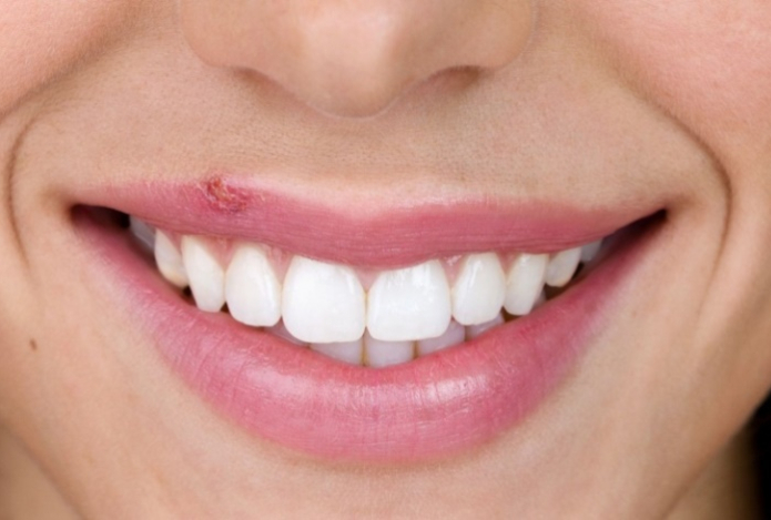 Эксперт озвучил неожиданные причины появления герпеса