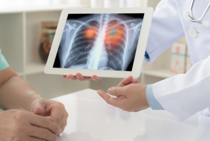 Врач назвала симптомы рака легких у некурящих людей