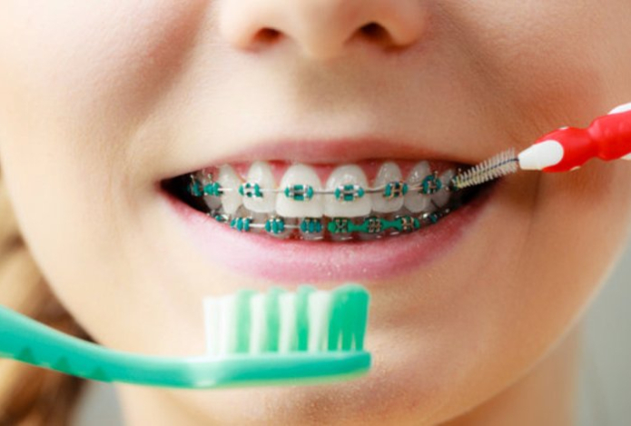 Стоматолог объяснила, как чистить зубы с брекетами