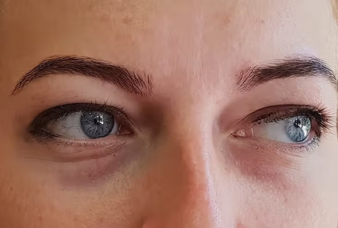 Врач рассказала о неочевидных причинах появления синяков