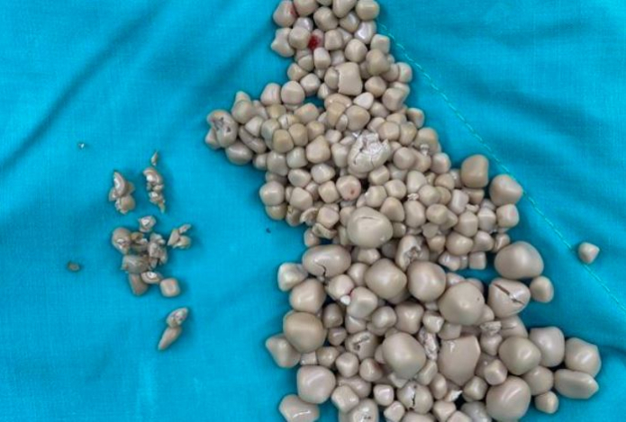 Врачи извлекли из почек женщины 300 камней. Все из-за её нелюбви к этому напитку