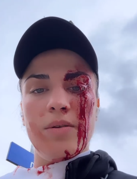 Пятеро мужчин избили ногами девушку-боксера из Чечни. Фото