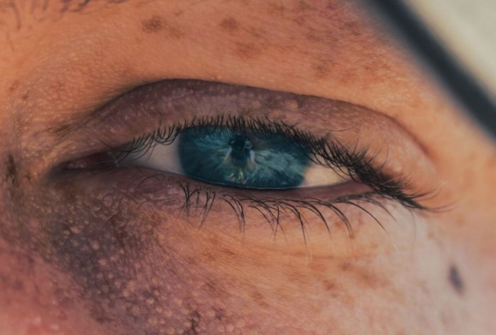 От недосыпания до аллергии. Пять причин, почему у вас круги под глазами