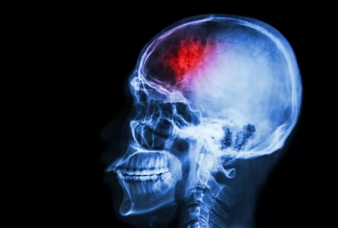 Невролог раскрыл симптомы, появляющиеся за несколько недель до инсульта