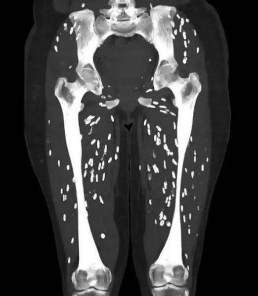 Врач показал страшные последствия употребления недожаренной свинины
