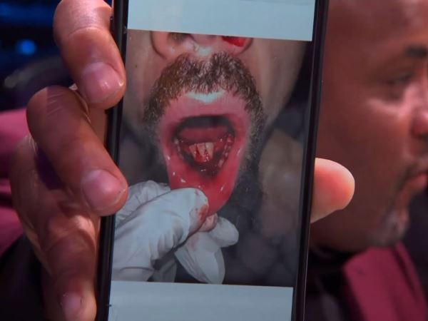 Появилось страшное фото последствий приема Хамзата Чимаева на UFC 308