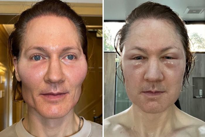Шокирующее фото. Миллиардер-биохакер показал последствия безумной процедуры для омоложения кожи