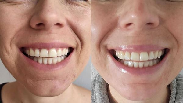 Девушка месяц полоскала рот оливковым маслом — вот что из этого вышло