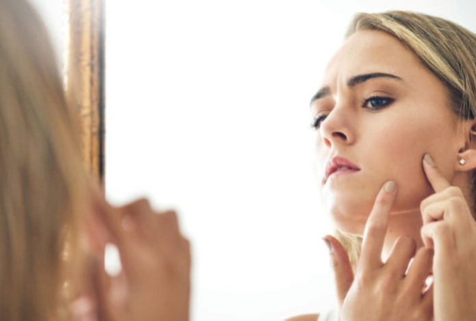 Дерматолог назвала неочевидную причину появления акне