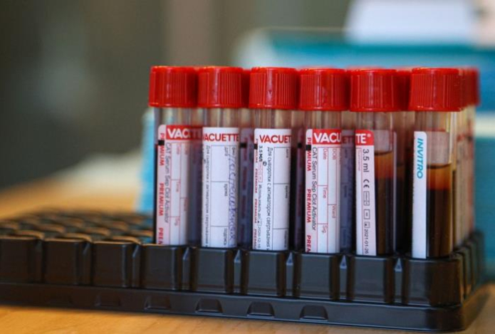 Врач раскрыла, при каком анализе на сахар нужно бить тревогу