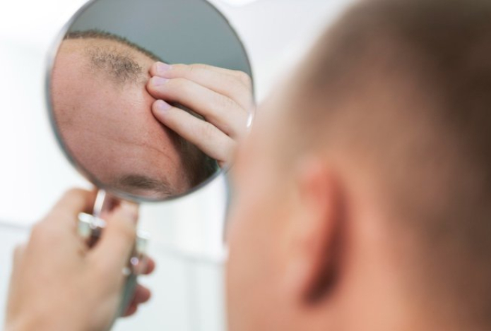 Неожиданная причина выпадения волос у мужчин