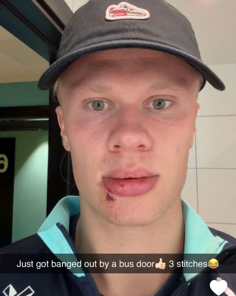 Эрлинг Холанд получил нелепую травму в сборной Норвегии. Фото