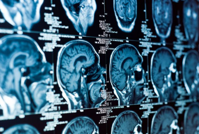 Как меняется форма мозга при деменции