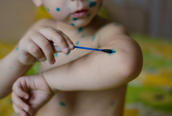 Всплеск ветрянки у детей — как вовремя заметить симптомы и помочь ребенку