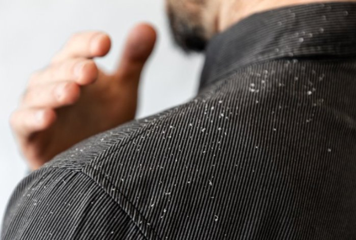 Миф или правда — заразна ли перхоть