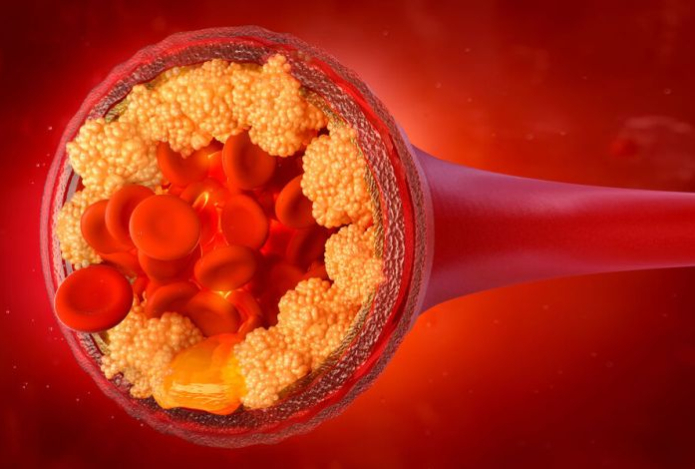 У снижения уровня «плохого» холестерина нашли опасность для здоровья