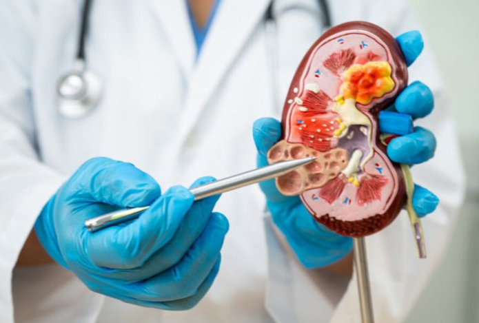 Из-за каких продуктов появляются камни в почках